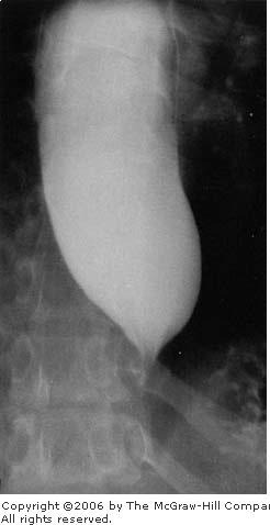 Barium esophagram with an enlarged esophagus narrowing at the lower end.