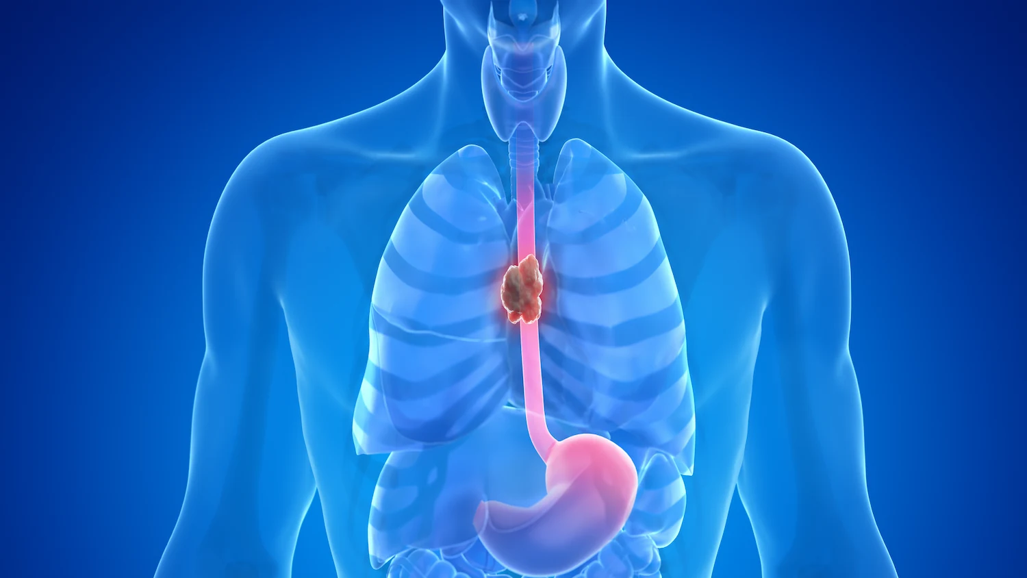Illustration of the esophagus and stomach with a tumor in the esophagus
