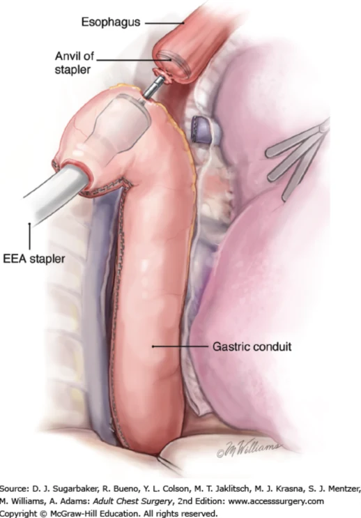 Teaching illustration showing a stomach tube, or gastric conduit, being connected to the remaining esophagus in the chest