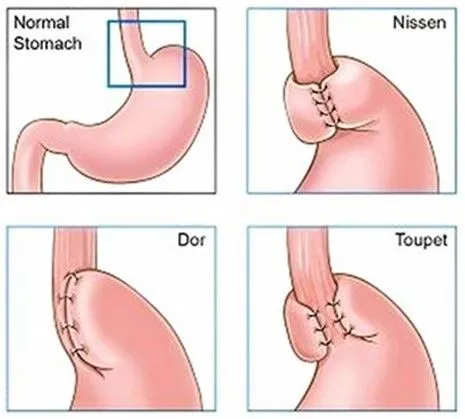Four-panel illustration showing the normal stomach and Nissen complete, Dor anterior partial, and Toupet posterior partial fundoplication wraps