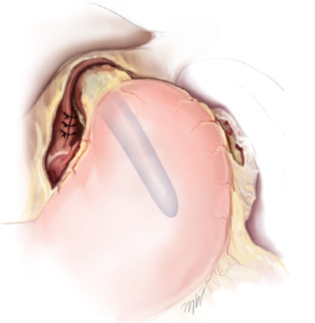 Illustration of sutures narrowing the opening in the diaphragm around the esophagus during hiatal hernia repair