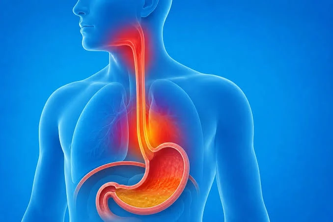 Illustration of the esophagus and stomach showing reflux of stomach contents into the esophagus