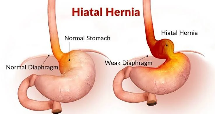 Illustration comparing a normal stomach below the diaphragm with a hiatal hernia extending above the diaphragm