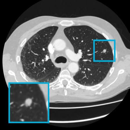 Chest CT with a lung nodule outlined in blue and an enlarged view in the lower-left inset.
