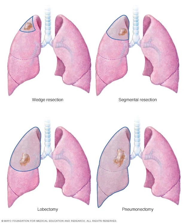 Illustration comparing wedge resection, segmentectomy, lobectomy, and removal of an entire lung