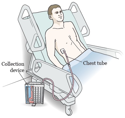 Chest tube entering between the ribs and connected to a collection device beside the bed