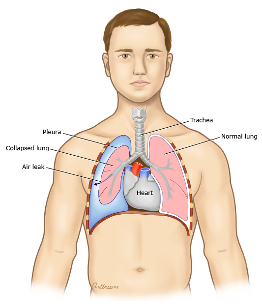 Normal lung compared with a lung partially collapsed by air in the pleural space